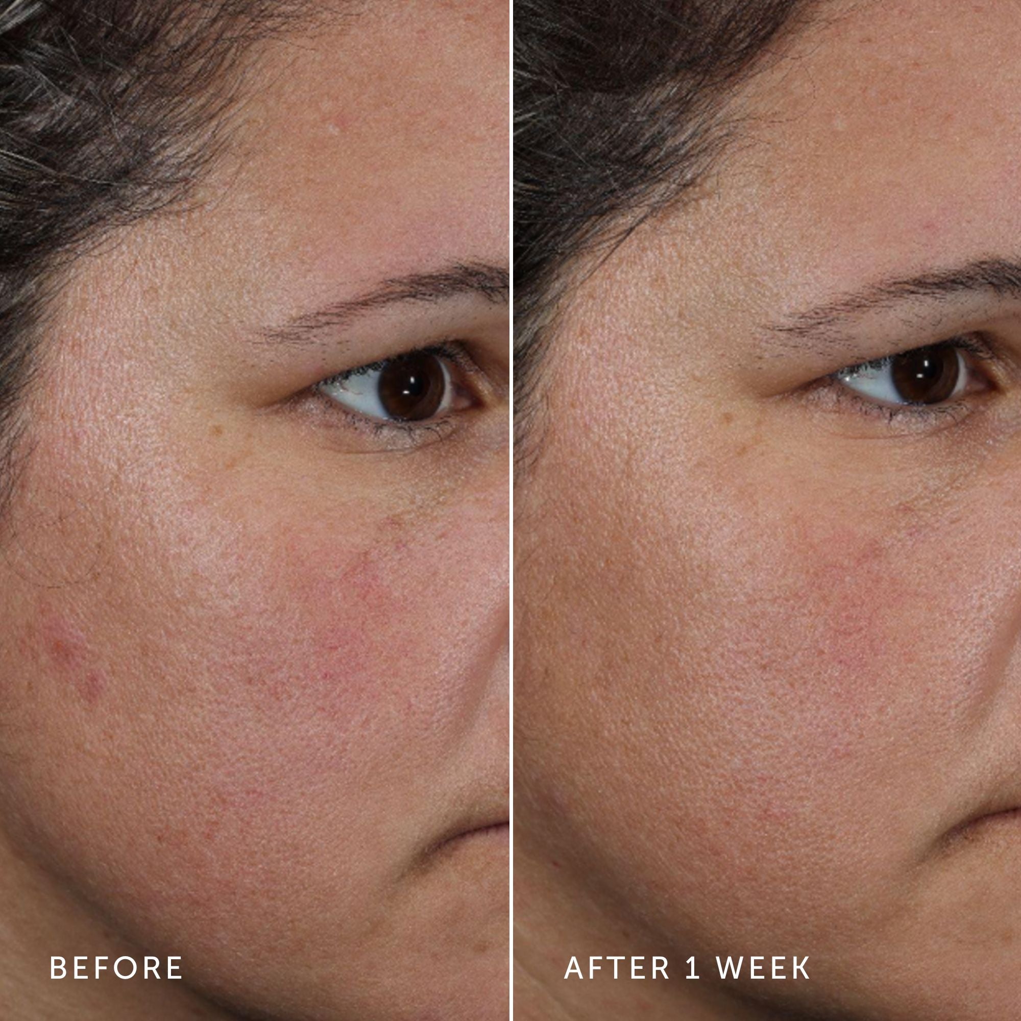 Before and after comparison of a person's face with visible skin improvement over one week.