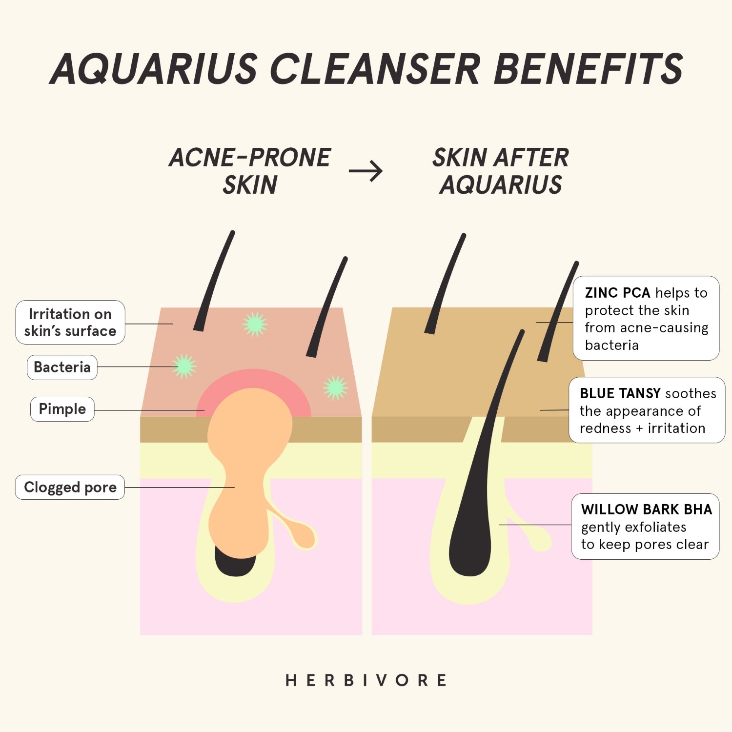 Infographic of acne-prone skin and what it looks like after using Aquarius Cleanser.